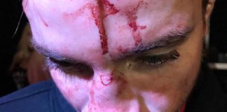 Przeraźliwe rozcięcie na czole zawodnika po walce na Valor Fights 47 (UWAGA, DRASTYCZNE!)
