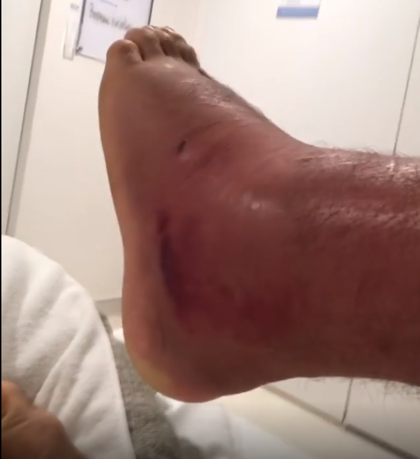 WIDEO: Alexander Volkanovski pokazuje zainfekowaną stopę