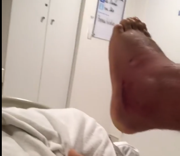 WIDEO: Alexander Volkanovski pokazuje zainfekowaną stopę