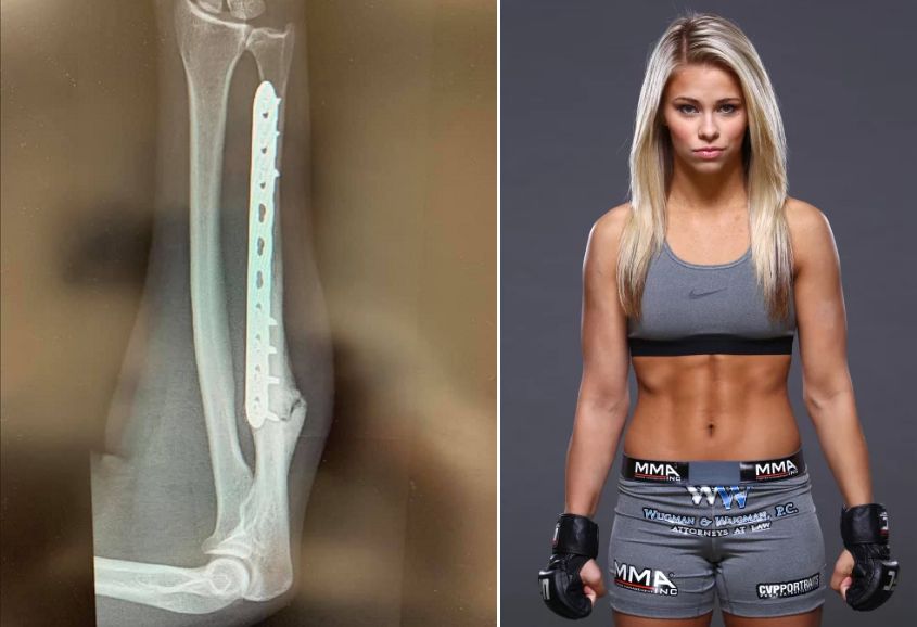 Paige VanZant znów kontuzjowana, złamana ręka wymaga operacji 