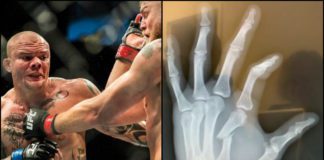 Anthony Smith złamał rękę w pierwszej rundzie walki z Alexandrem Gustafssonem