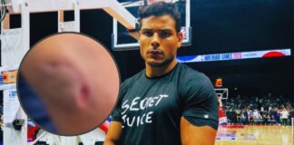 Paulo Costa pokazuje zdjęcie zainfekowanego łokcia, przez którego wypadł z UFC 294