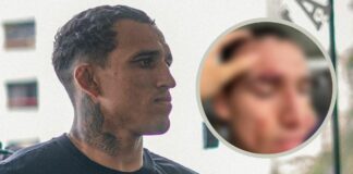 Charles Oliveira pokazuje fatalne rozcięcie, przez które wypadł z UFC 294